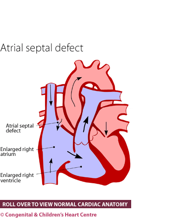 Atrial septal defect